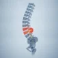 Ilustrație a coloanei lombare cu un disc intervertebral herniat care apasă pe o rădăcină nervoasă.